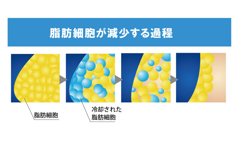 脂肪冷却施術　脂肪減少の過程